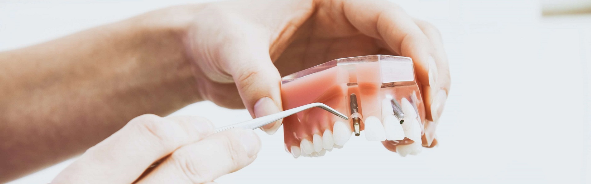 Farmkom | Zubni implanti